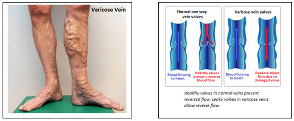 Varicose Veins, Laser Haemorrhoids, Vascular Surgery Treatment